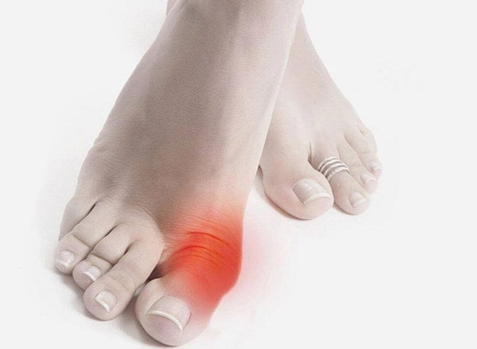 gout foot symptoms