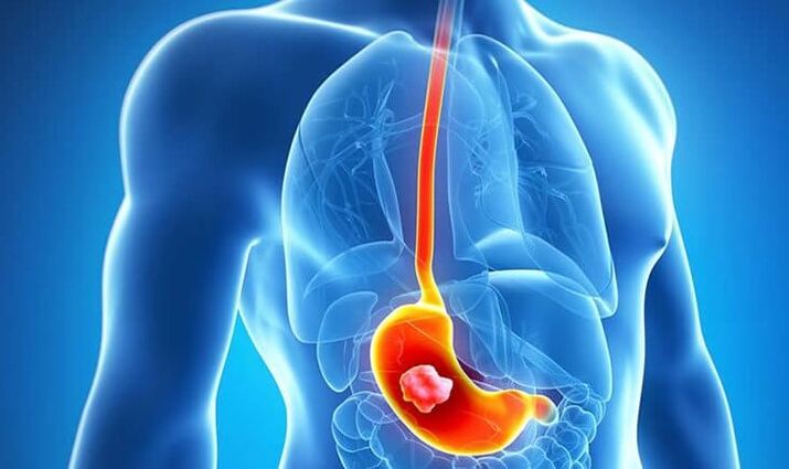 If you have a stomach ulcer, following the Dukan diet is contraindicated.